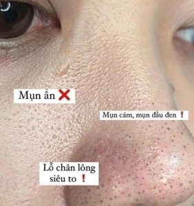 Dung dịch tẩy da chết, ngừa mụn BHA Obagi Clenziderm MD Pore Therapy 148ml