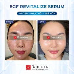 Huyết thanh siêu tái tạo tế bào gốc EGF Revitalize Serum Dr.Hedison 50ml