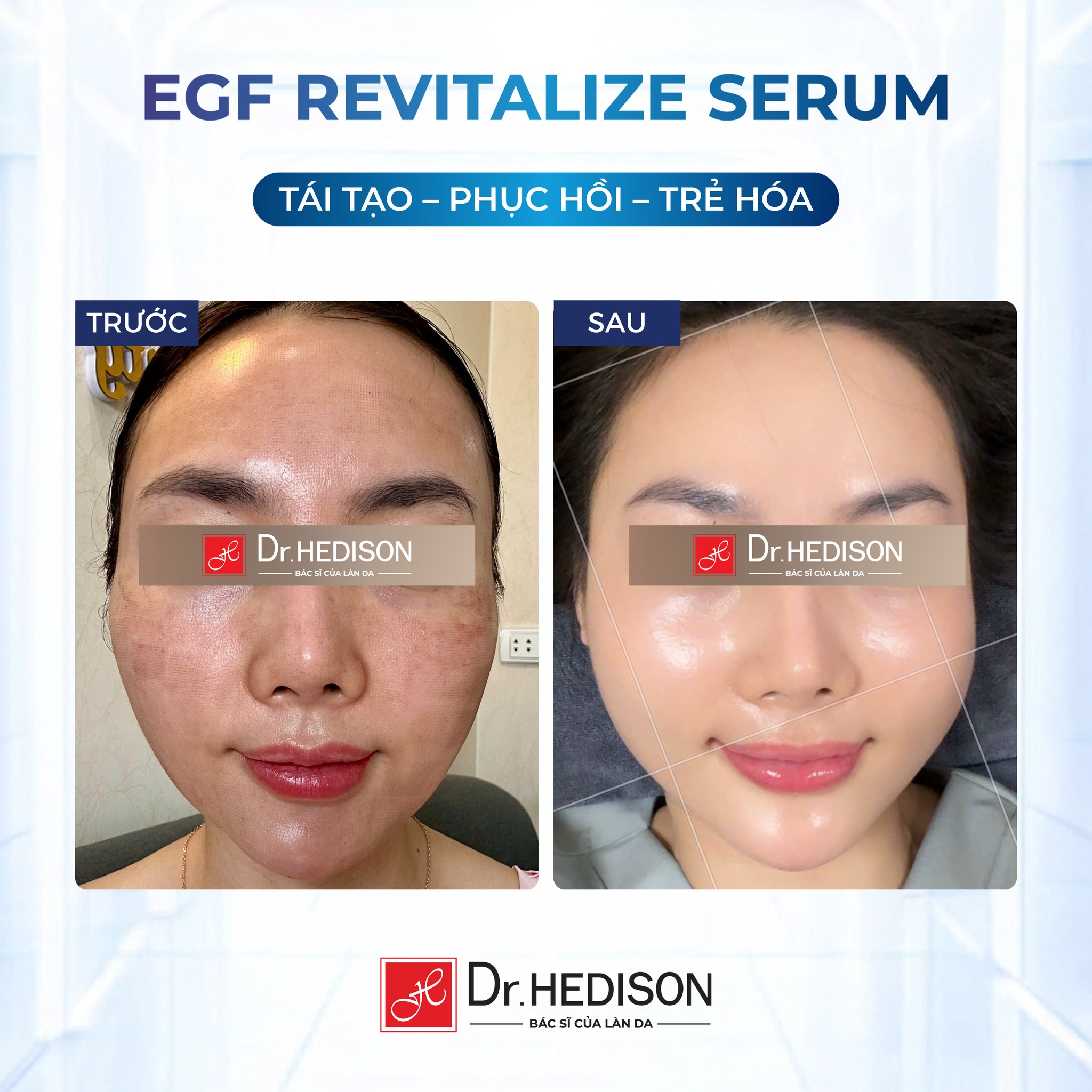 Huyết thanh siêu tái tạo tế bào gốc EGF Revitalize Serum Dr.Hedison 50ml