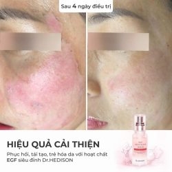 Huyết thanh siêu tái tạo tế bào gốc EGF Revitalize Serum Dr.Hedison 50ml