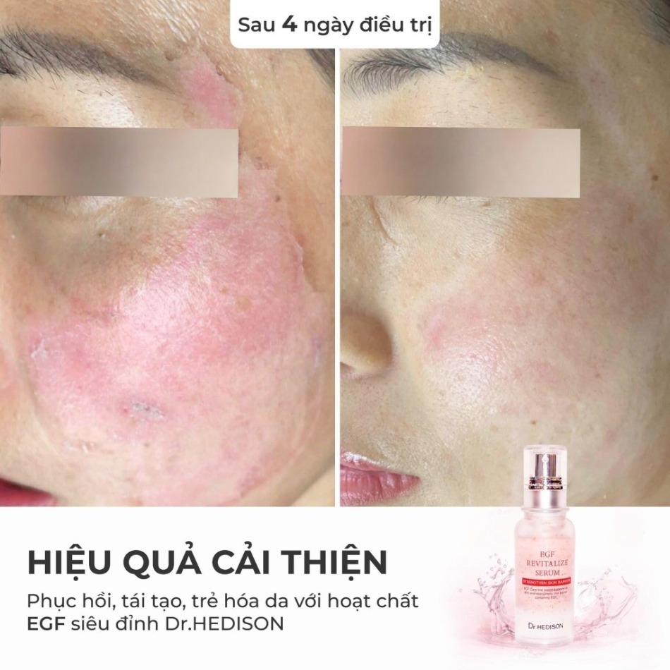 Huyết thanh siêu tái tạo tế bào gốc EGF Revitalize Serum Dr.Hedison 50ml