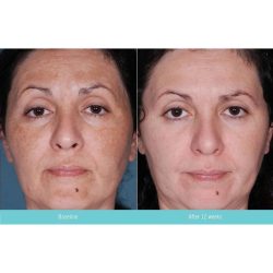 Kem trị nám tàn nhang Obagi Nu-derm Clear số 3 - 57g
