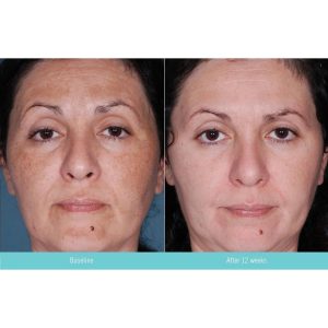 Kem trị nám tàn nhang Obagi Nu-derm Clear số 3 - 57g