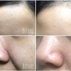 Nước hoa hồng Dr.Hedison AHA 3% Scaling Toner (150ml)