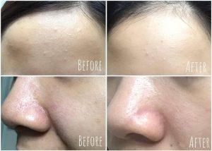 Nước hoa hồng Dr.Hedison AHA 3% Scaling Toner (150ml)