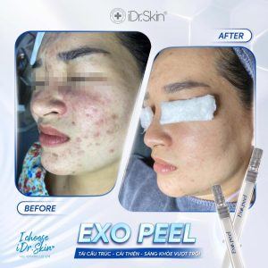Peel vật lý căng bóng da Idr.Skin iDr.Exo Peel