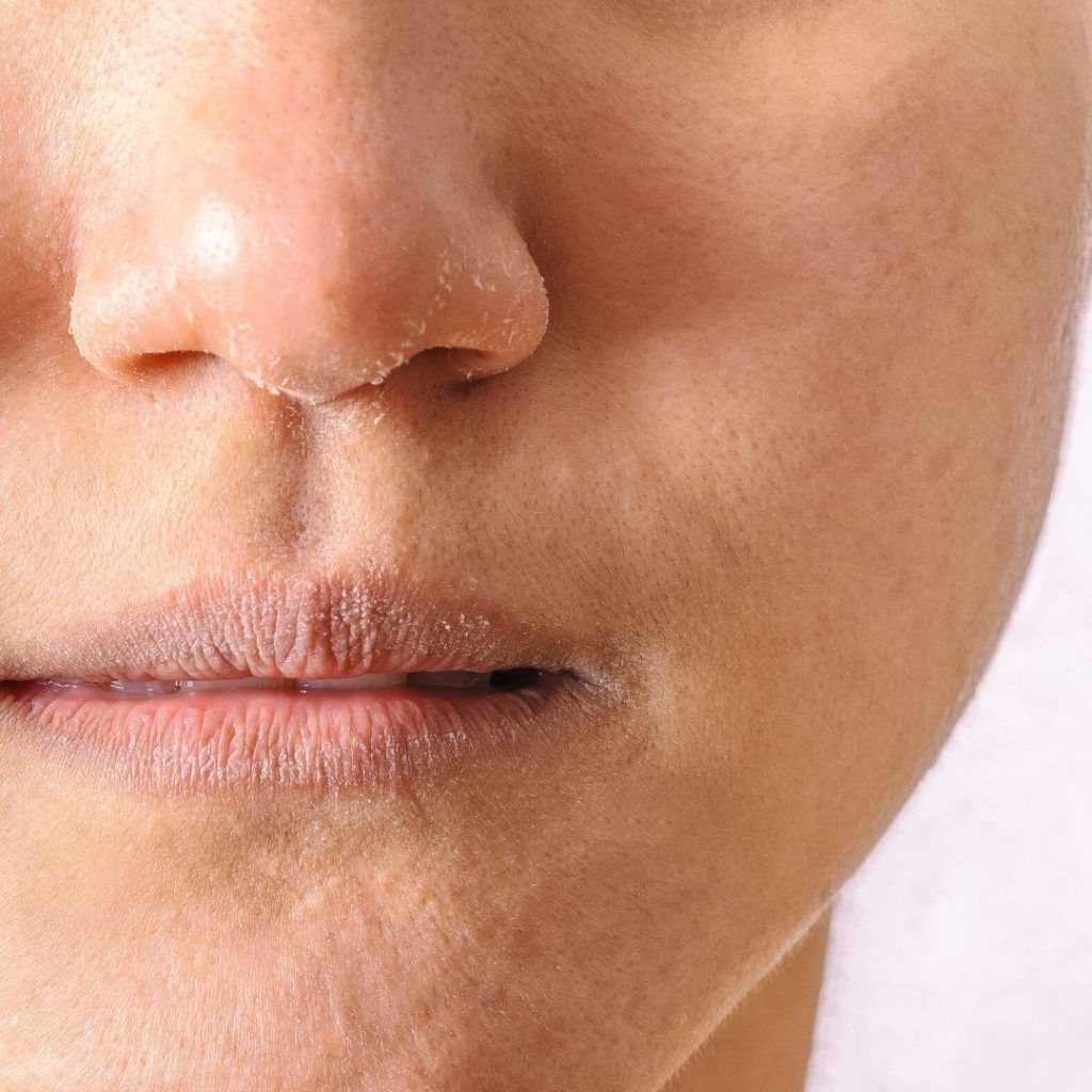 Serum Cho Da Khô Nên Dùng Gì Để Da Mềm Mịn
