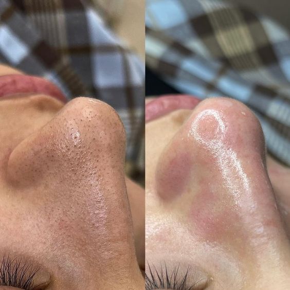 Các Phương Pháp Loại Bỏ Mụn Đầu Đen Hiện Nay