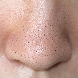 Các Phương Pháp Loại Bỏ Mụn Đầu Đen Hiện Nay