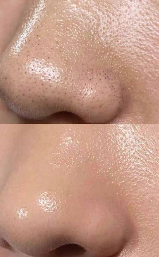 Cách Ngăn Ngừa Mụn Đầu Đen Quay Trở Lại