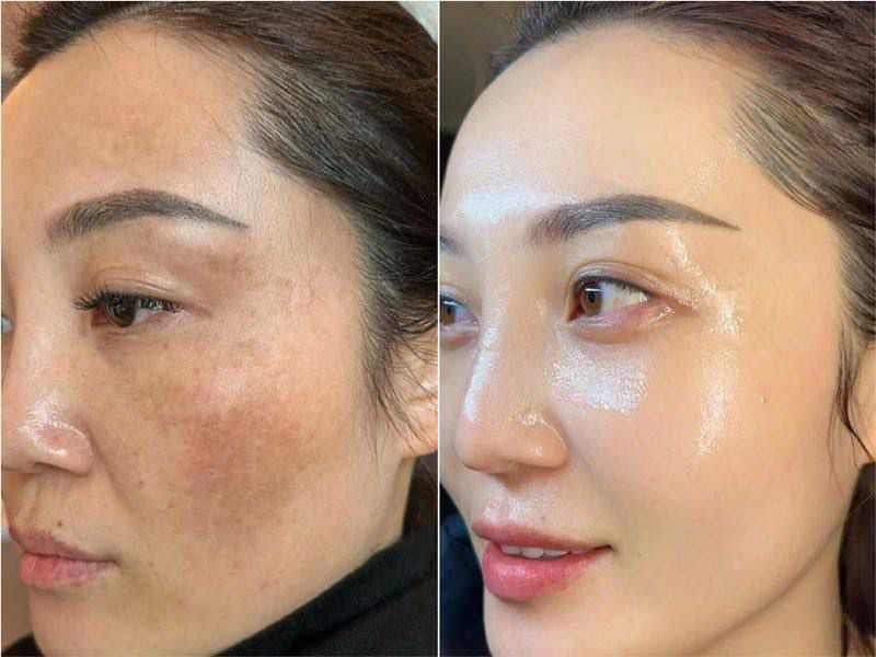 Cách Ngăn Ngừa Nám Da Quay Trở Lại