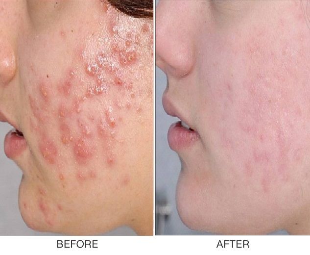 Da Mụn Nên Tránh Những Gì
