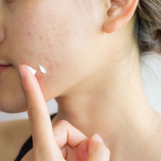 Mụn Hoài Không Hết. Vai Trò Của Niacinamide