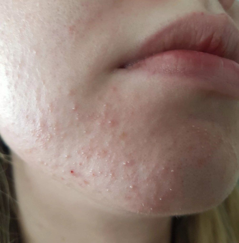 Những Sai Lầm Khi Dùng Tretinoin Trị Mụn