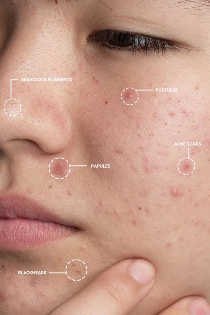 Routine Skincare Cho Da Đang Điều Trị Mụn