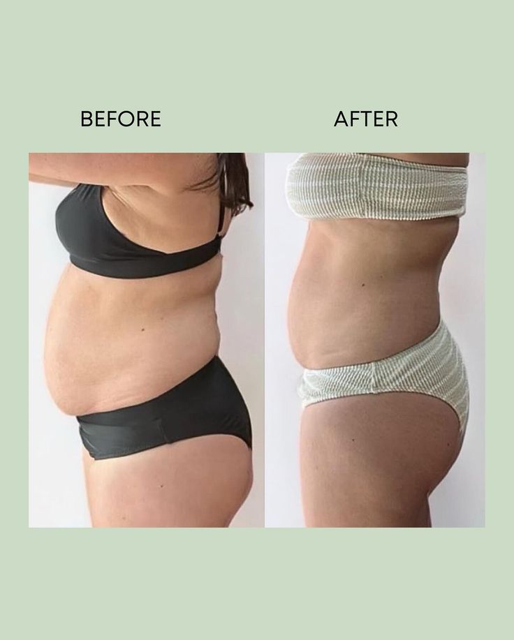 Tiêm tan mỡ có phải giải pháp phù hợp cho mỡ cục bộ lâu năm