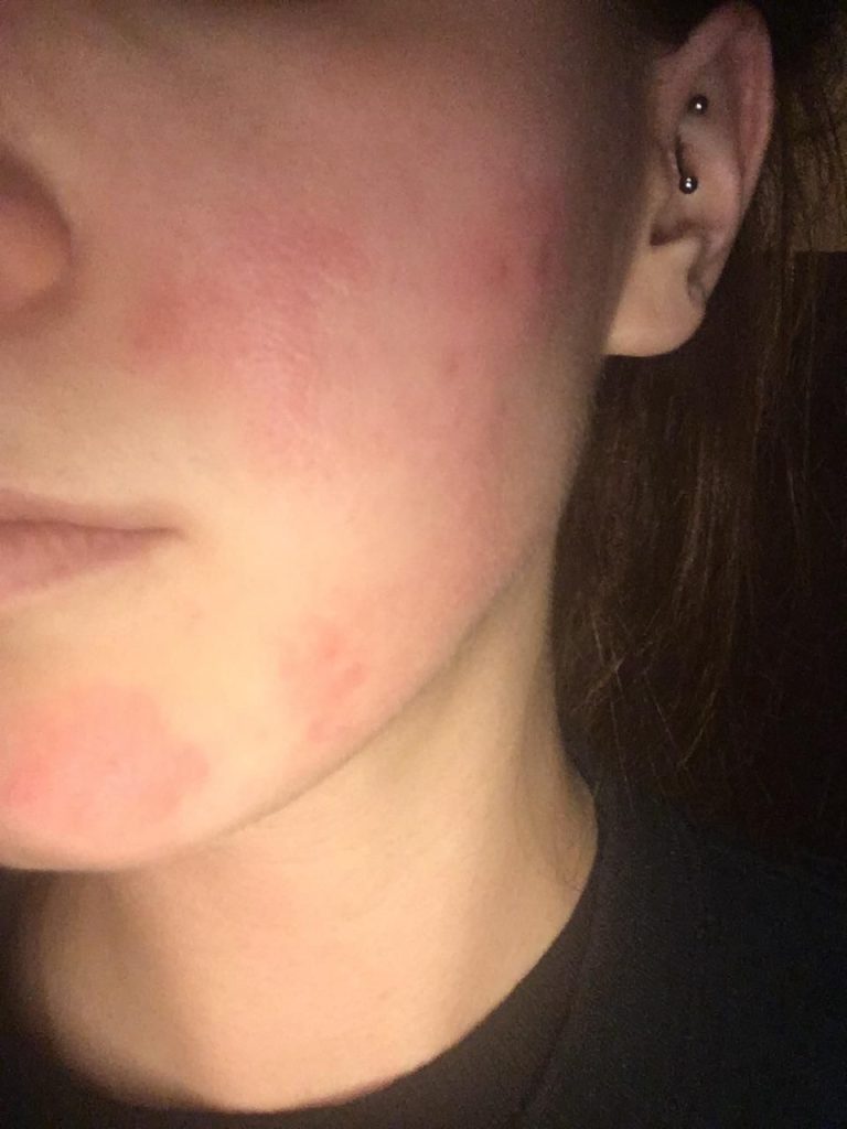 Vì Sao Có Người Dùng Retinol Bị Kích Ứng Nặng