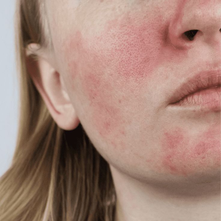 Vì Sao Dùng Niacinamide Bị Châm Chích, Đỏ Da