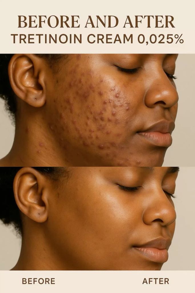 Vì Sao Dùng Tretinoin Trị Mụn Mãi Không Khỏi