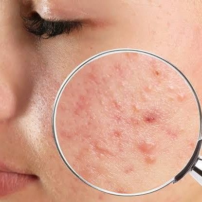 Vì Sao Dùng Tretinoin Trị Mụn Mãi Không Khỏi