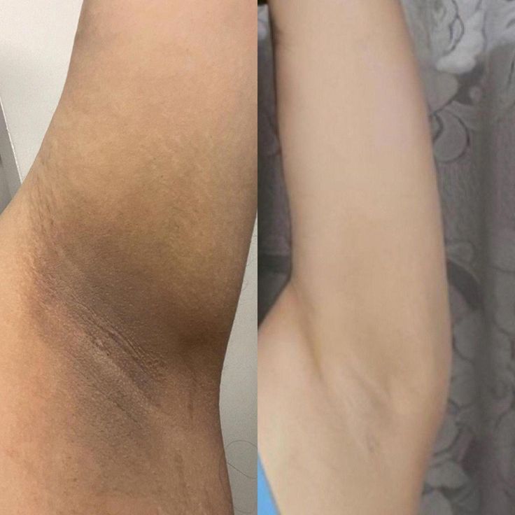Vì Sao Nách Bị Thâm Đen