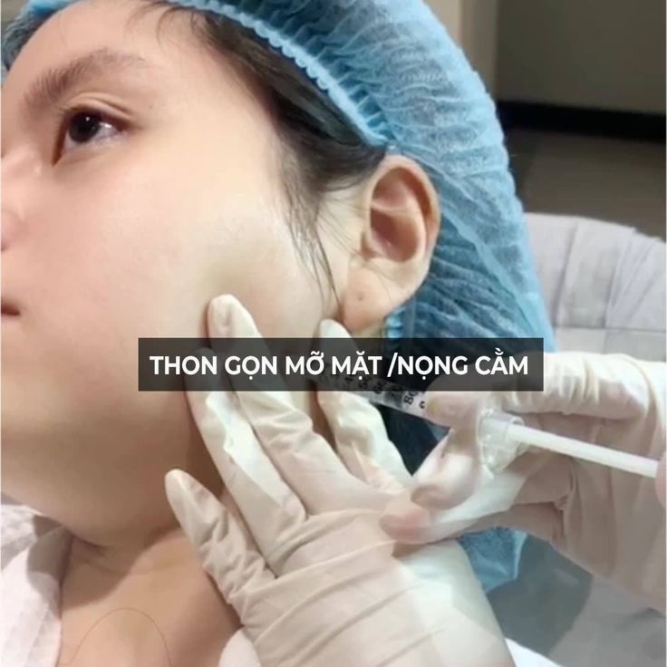 tiêm tan mỡ nọng cằm
