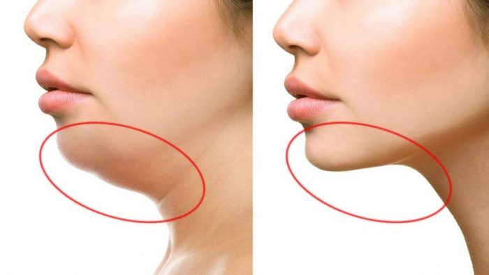 tiêm tan mỡ nọng cằm