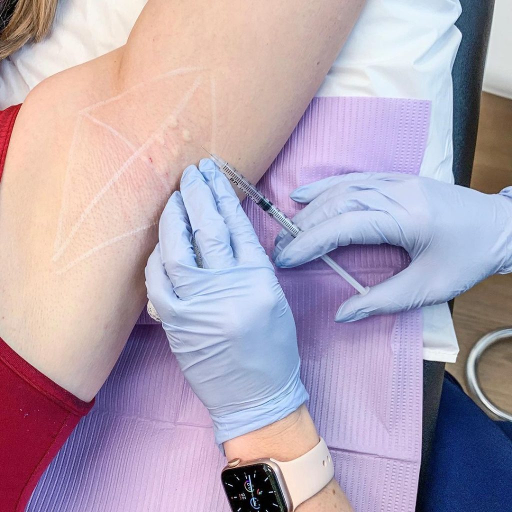 Điều Trị Mồ Hôi Nách Không Phẫu Thuật Bằng Botox Hiệu Quả