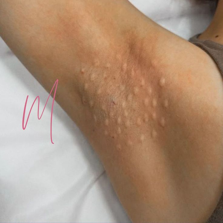 Điều Trị Mồ Hôi Nách Không Phẫu Thuật Bằng Botox Hiệu Quả