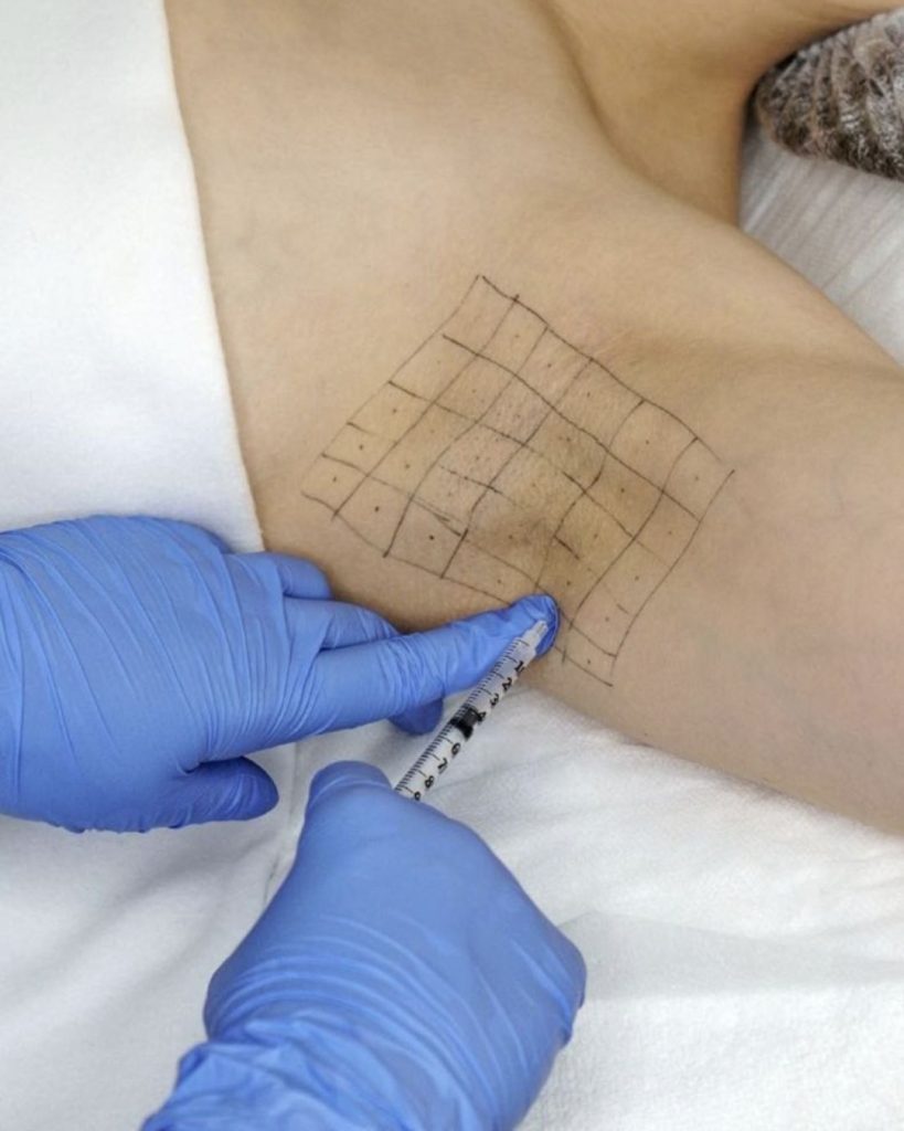 Điều Trị Mồ Hôi Nách Không Phẫu Thuật Bằng Botox Hiệu Quả