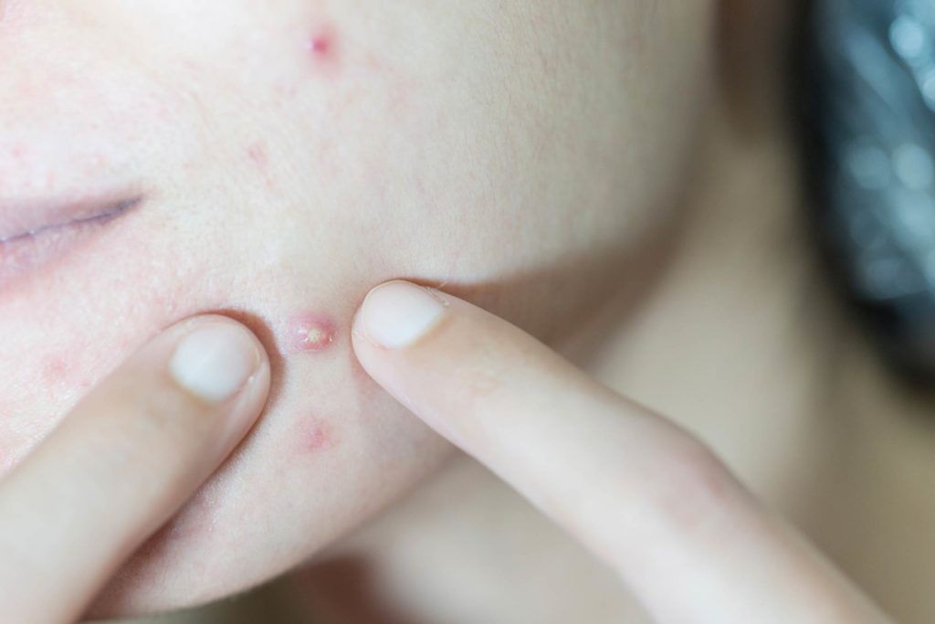 Mụn Bọc Do Nội Tiết Có Đúng Không