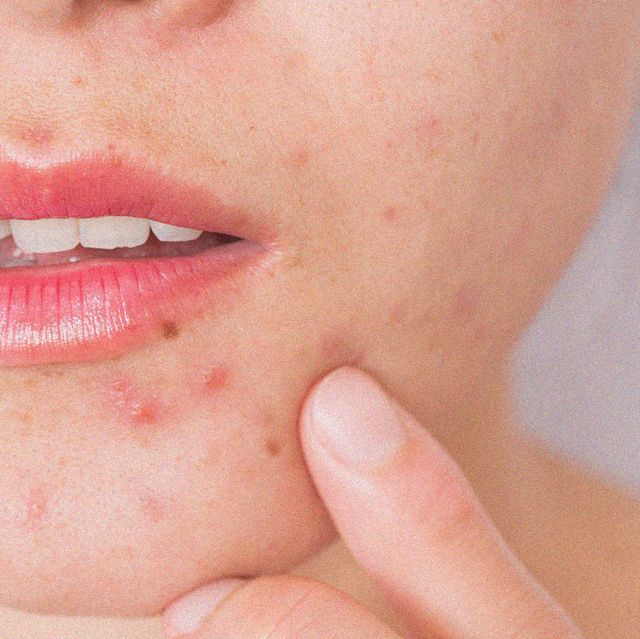 Mụn nội tiết nên ăn gì và kiêng gì để nhanh hết