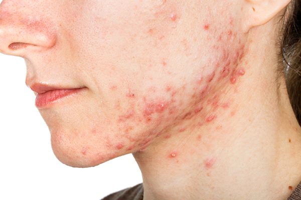 Mụn nội tiết nên ăn gì và kiêng gì để nhanh hết