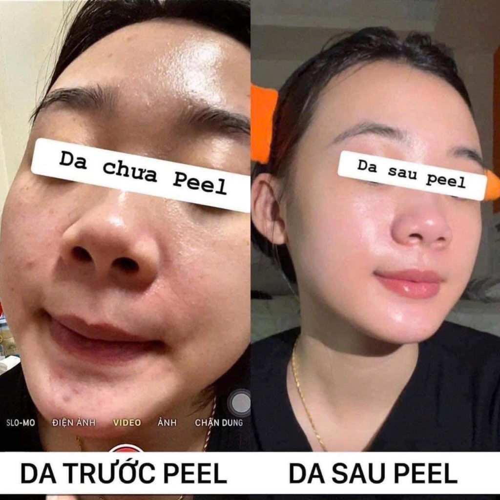 Peel Da Trị Mụn Có Làm Da Mỏng Và Yếu Đi Không