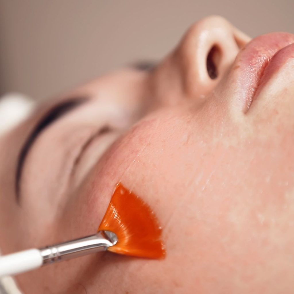 Peel Da Trị Mụn Có Làm Da Mỏng Và Yếu Đi Không