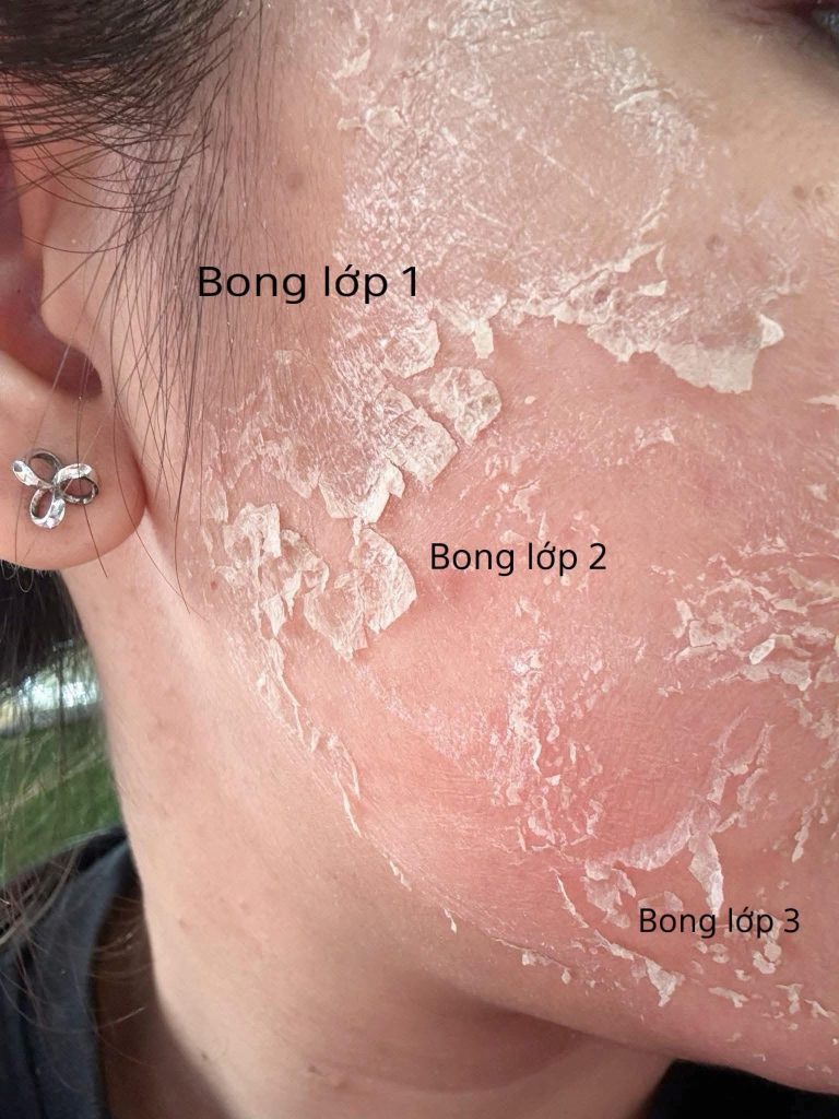 Peel Da Trị Mụn Có Làm Da Mỏng Và Yếu Đi Không