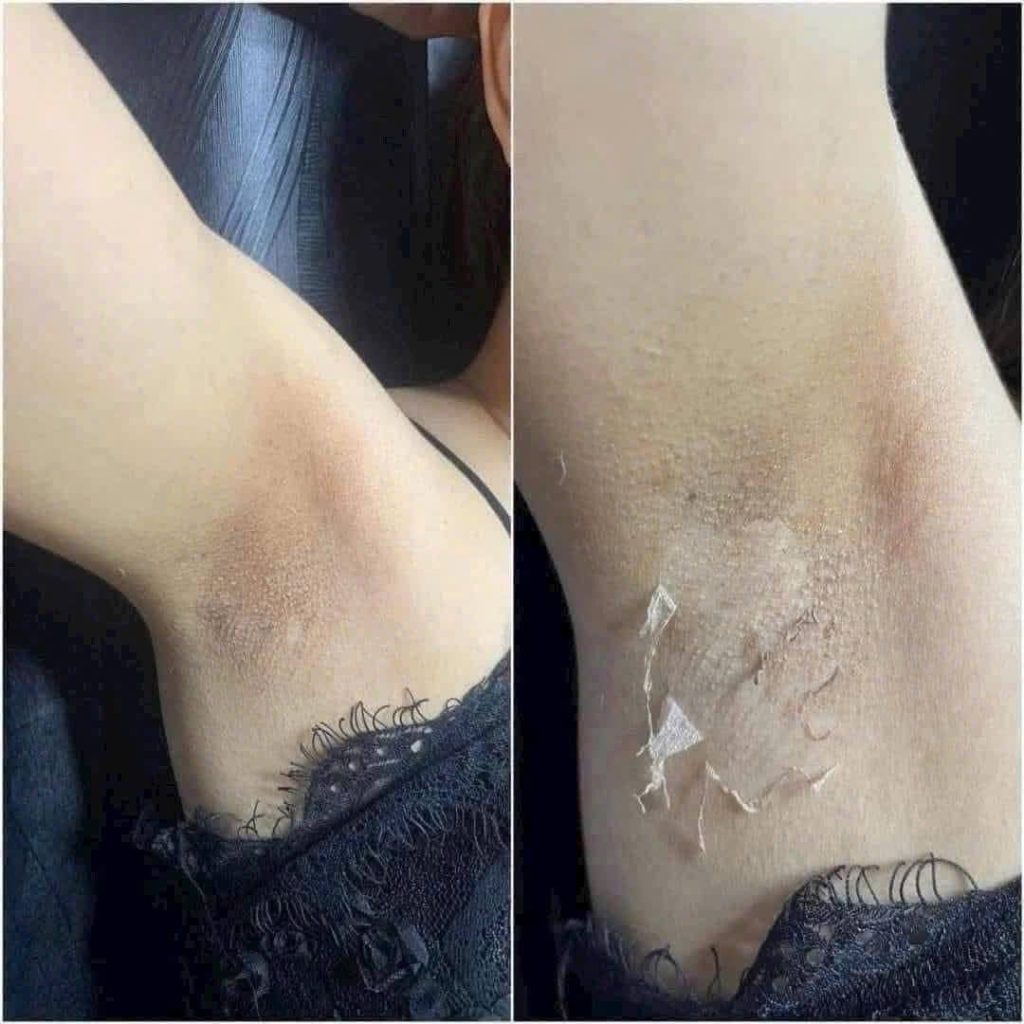 Peel Da Trị Thâm Nách Có Hiệu Quả Không