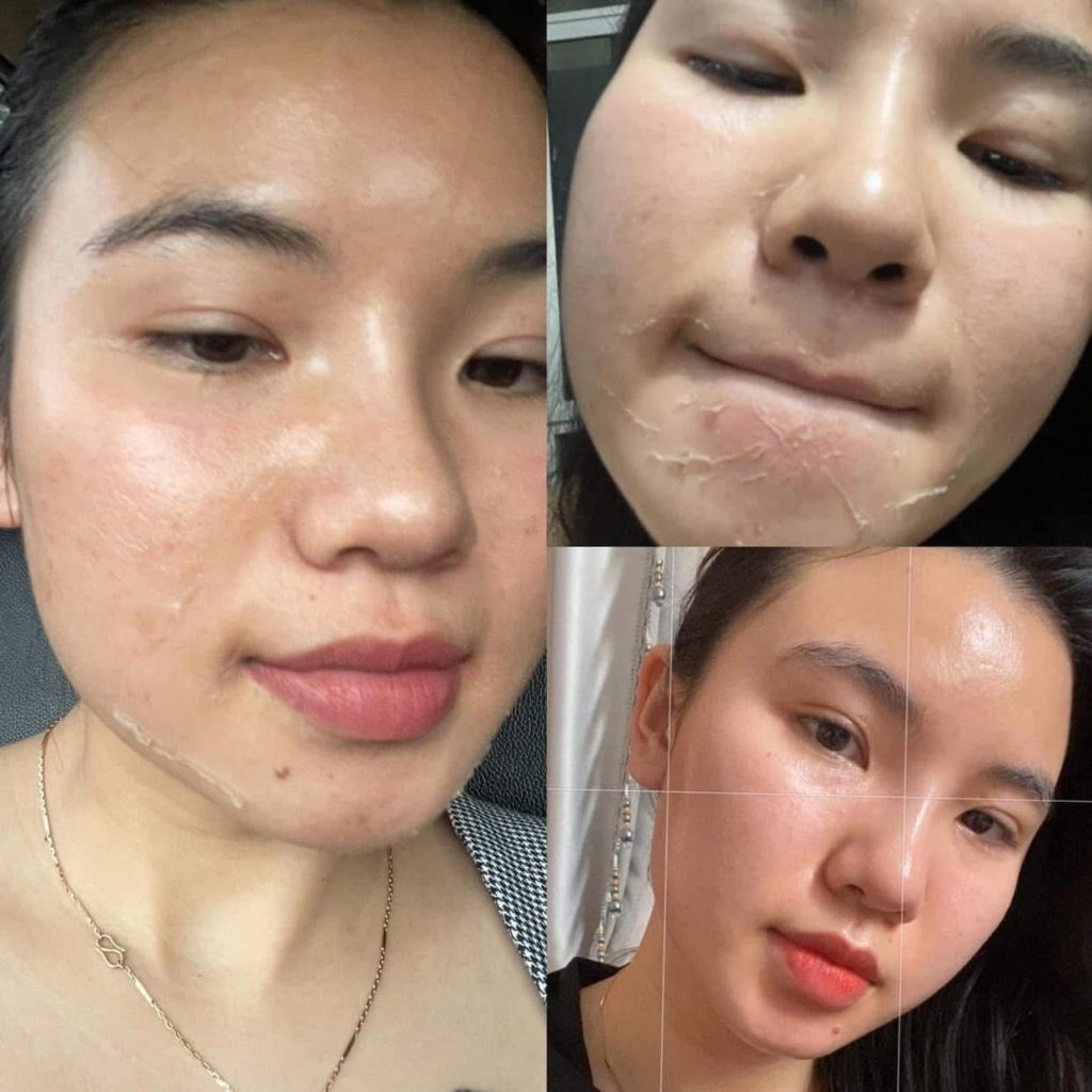 Peel da trị mụn giúp gì cho làn da