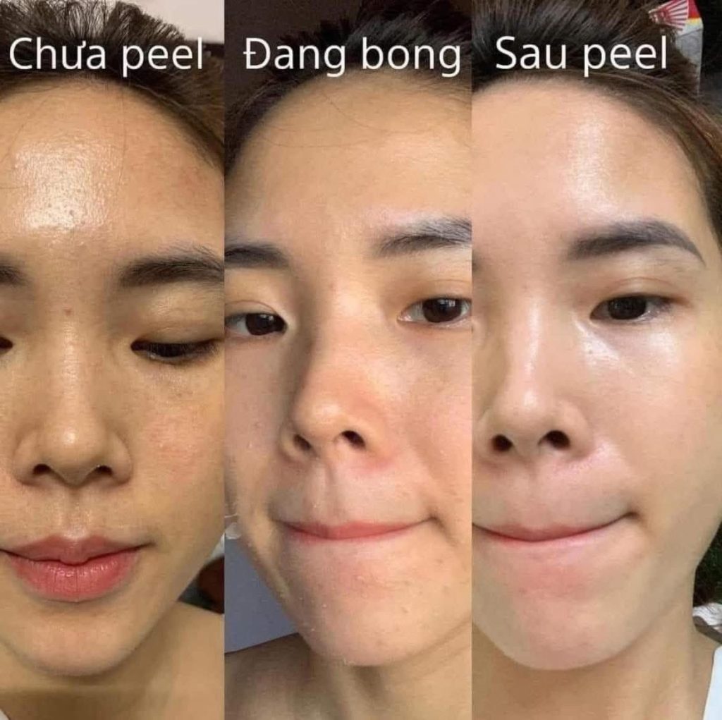 Peel da trị mụn giúp gì cho làn da