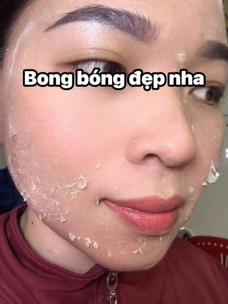 Peel da trị mụn giúp gì cho làn da