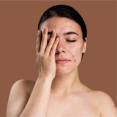 Review trị mụn