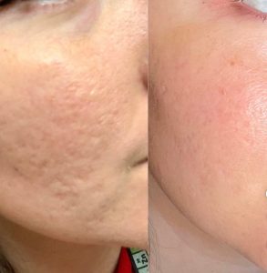 Sẹo Rỗ Có Trị Hết Hoàn Toàn Không