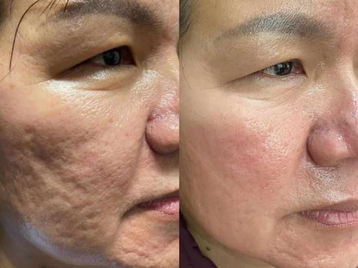 Sẹo Rỗ Có Trị Hết Hoàn Toàn Không