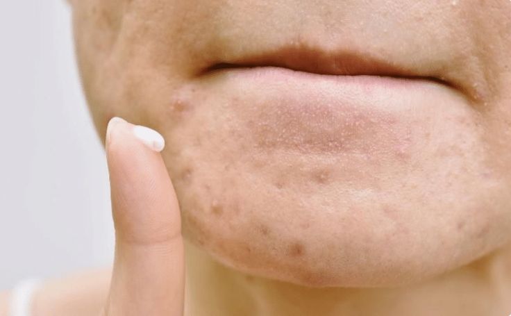 Tretinoin Có Dùng Hàng Ngày Được Không