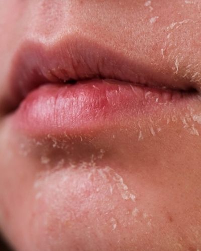 Tretinoin bị bong da. 5 nguyên nhân & cách xử lý nhanh