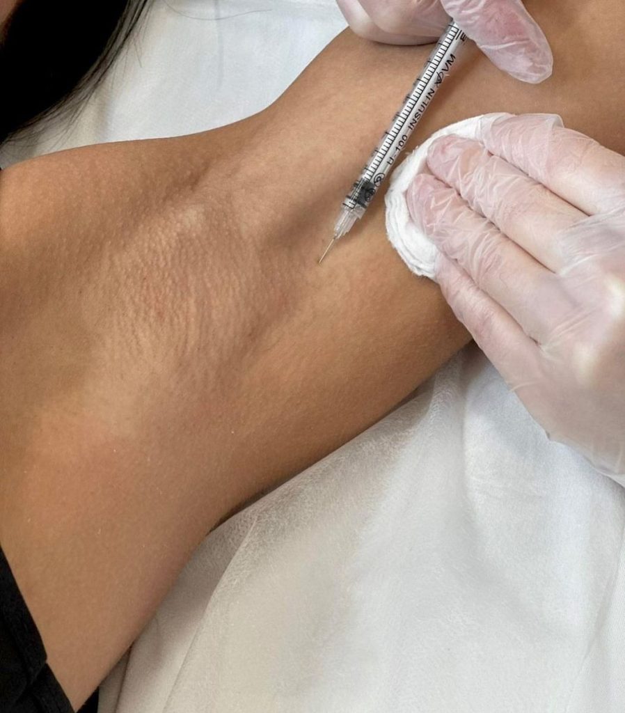 Vì Sao Botox Có Thể Giảm Tiết Mồ Hôi Nách