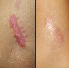 Vì Sao Da Hình Thành Sẹo Sau Khi Bị Tổn Thương