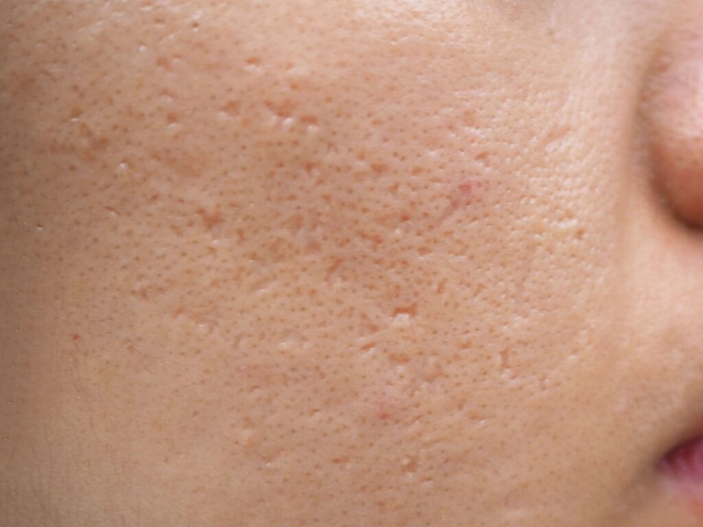 Vì Sao Da Hình Thành Sẹo Sau Khi Bị Tổn Thương