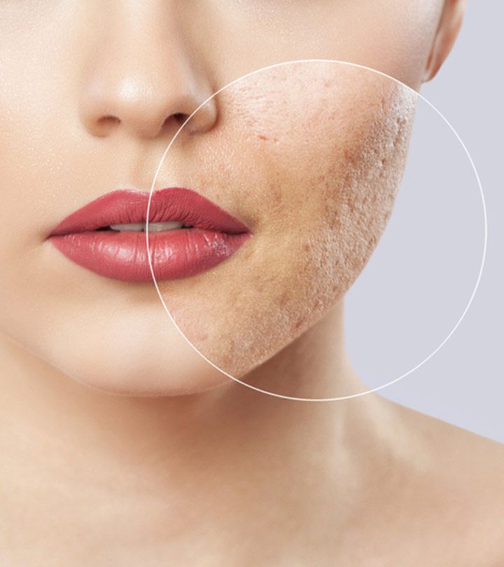 Vì Sao Mụn Viêm Dễ Gây Sẹo Đáy Nhọn