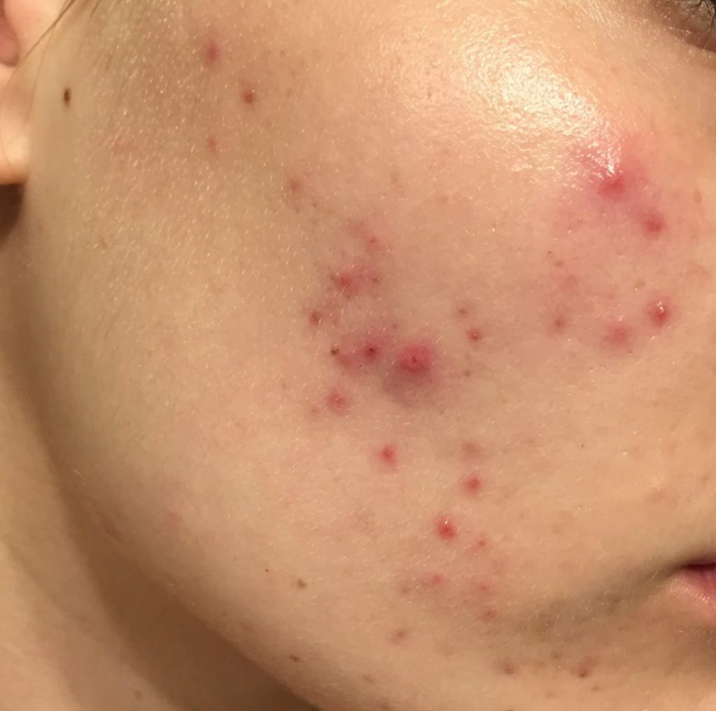 Vì Sao Mụn Viêm Dễ Gây Sẹo Đáy Nhọn